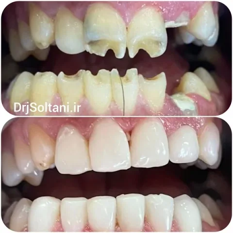 لمینت کامپوزیتی